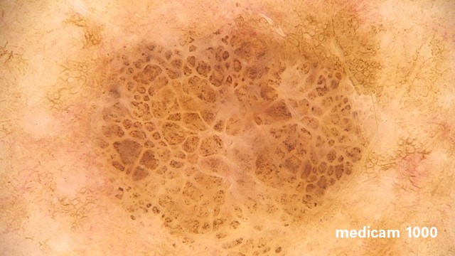 Макро фотографія родимки дерматоскопом Медікам 1000